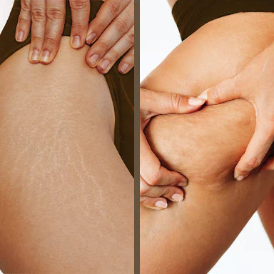 Fab Oils Cellulite and stretch marks - what's the difference?
